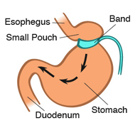 bariatric-illustration-lapband-190x190