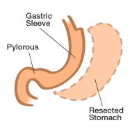 bariatric-illustration-sleeve-190x190