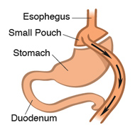 bariatric-illustrations-roux-en-y-190x190