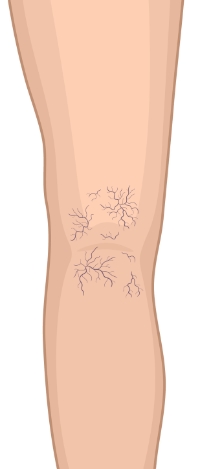 Stage-1-Spider-Veins
