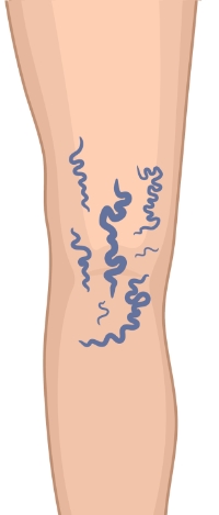 Stage-2-Varicose-Veins