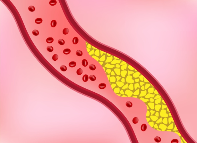 Cholesterol in blood vessel